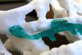 The world's first 3D jaw bone graft surgery