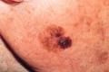 He invented two new drugs to treat melanoma