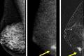 3D ultrasound helps detect breast cancer early