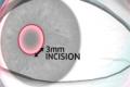 New contact lenses technology implanted directly into the eye