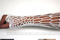 A new way to treat broken bones: Bundle with 3D print material