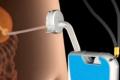 Weight loss with food suction