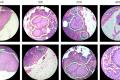 Google created a augmented reality microscope capable of detecting cancer