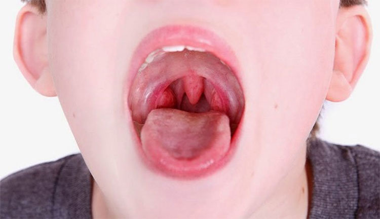 Picture 3 of 10 causes the throat to feel entangled
