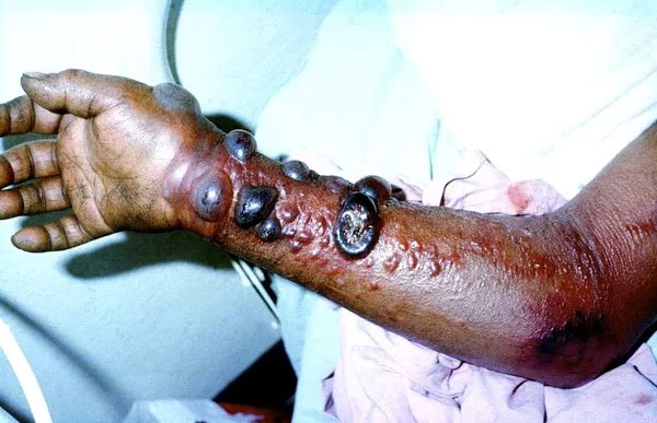Picture 2 of 10 diseases will kill you in just 24 hours