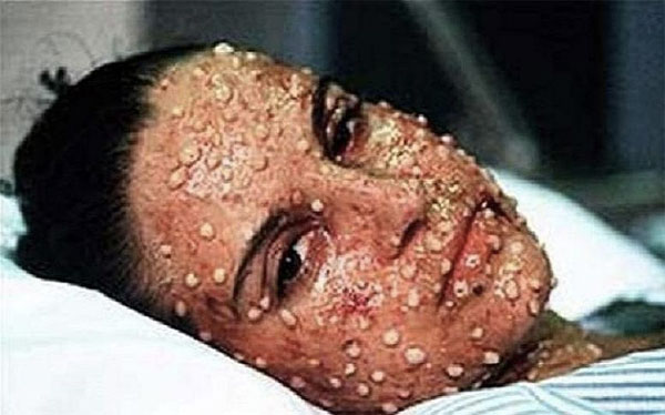 Picture 3 of 10 diseases will kill you in just 24 hours