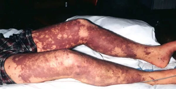 Picture 9 of 10 diseases will kill you in just 24 hours