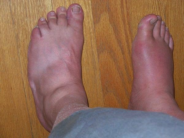 Picture 1 of 10 symptoms of kidney failure