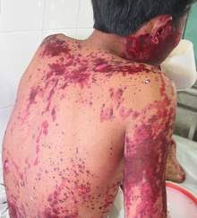 Picture 2 of 10 symptoms of kidney failure