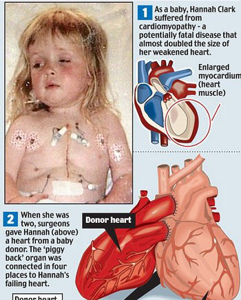 Picture 1 of 10 years living with two hearts in the chest