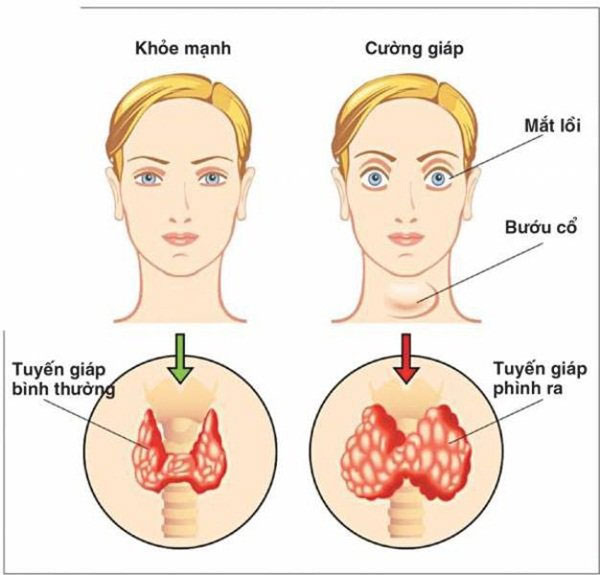 Picture 1 of 11 complications of unpredictable dangerous thyroid failure need to know