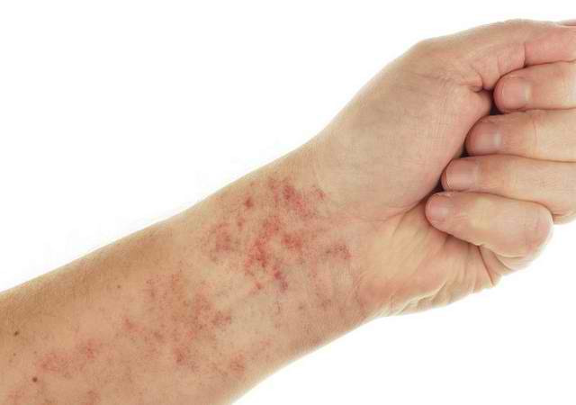 Picture 3 of 12 warning signs of lupus erythematosus