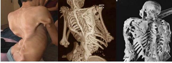 Picture 11 of 14 most bizarre diseases in the world