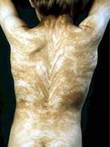 Picture 4 of 14 most bizarre diseases in the world