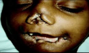 Picture 6 of 14 most bizarre diseases in the world