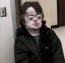 Picture 7 of 14 most bizarre diseases in the world