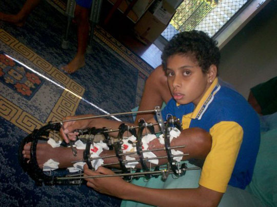 Picture 1 of 14 years old, stretching 29cm of leg bone