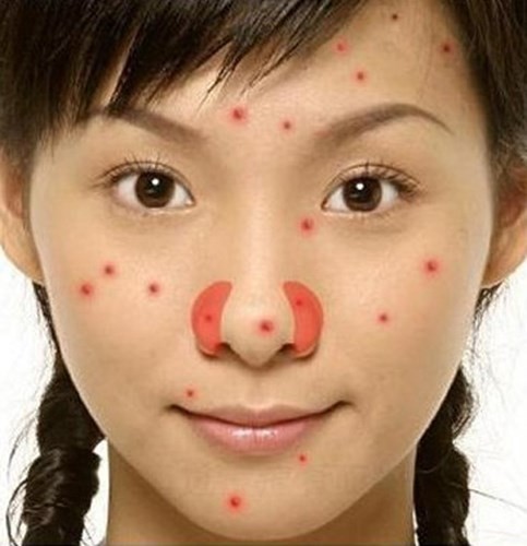 Picture 3 of 15 positions of acne warnings about health