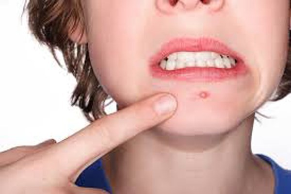 Picture 4 of 15 positions of acne warnings about health