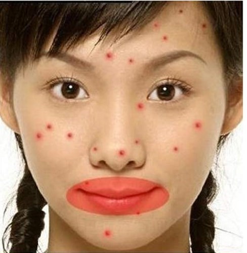 Picture 5 of 15 positions of acne warnings about health