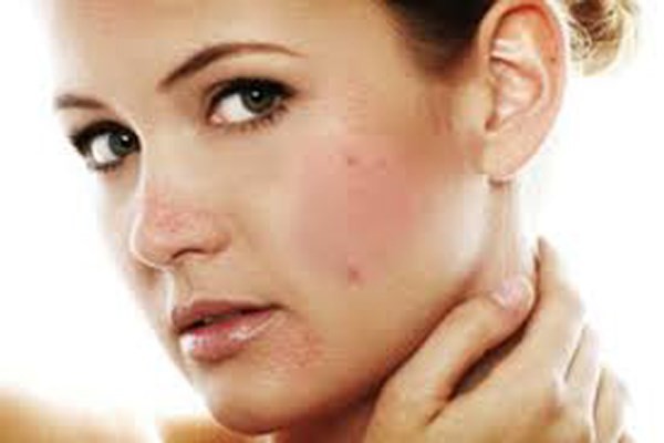 Picture 6 of 15 positions of acne warnings about health