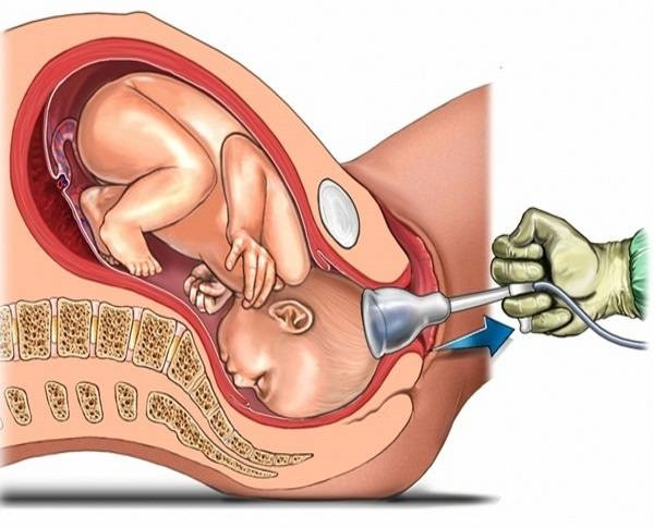 Picture 2 of 2 benefits and harms of caesarean section compared to normal delivery