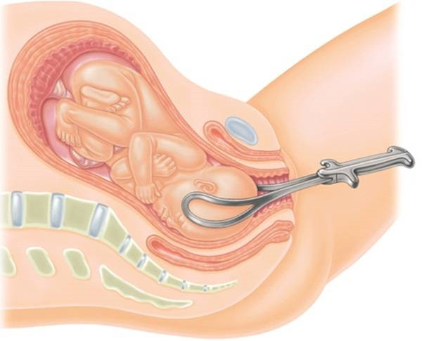 Picture 3 of 2 benefits and harms of caesarean section compared to normal delivery