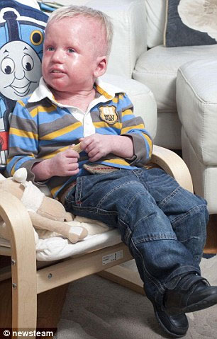 Picture 3 of 3-year-old baby has red skin