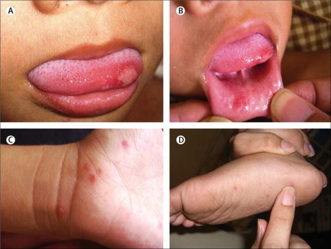 Picture 1 of 4 mistakes when caring for children with hand, foot and mouth disease