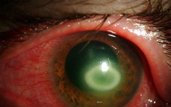 Picture 2 of 4 types of parasites that are extremely dangerous to eat meat
