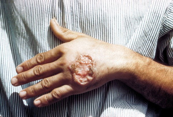 Picture 6 of 4 types of parasites that are extremely dangerous to eat meat