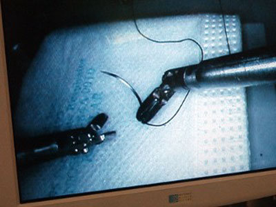 Picture 4 of 5 breakthrough medical advances in the decade