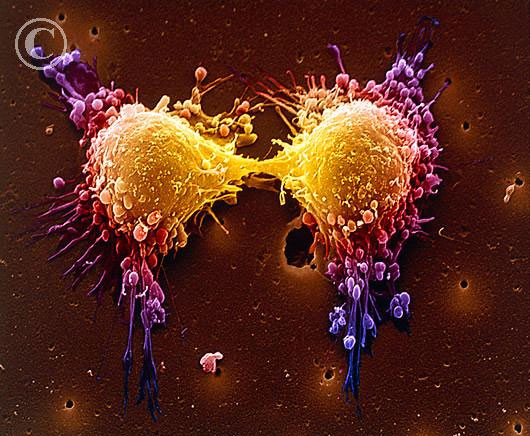 Picture 1 of 5 gene variants related to prostate cancer