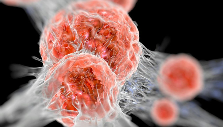 Picture 4 of 5 incurable diseases are misunderstood badly
