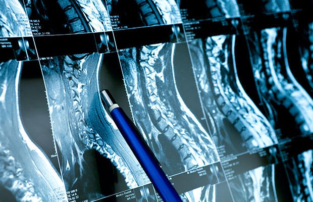 Picture 4 of 5 types of cancer you have never heard of