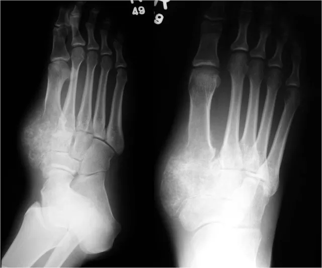 Picture 5 of 5 types of cancer you have never heard of