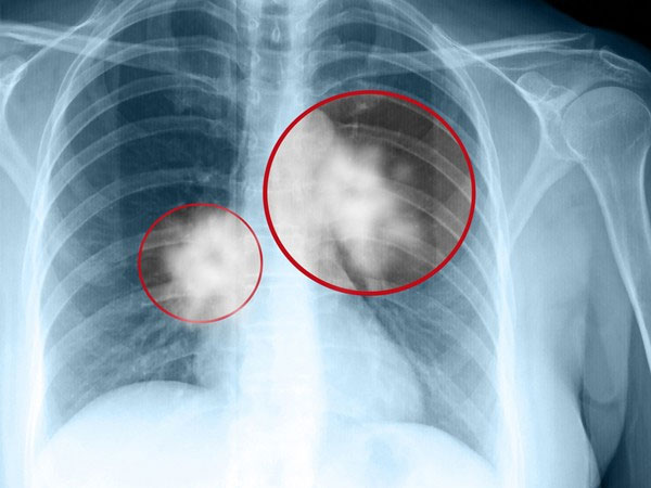 Picture 4 of 6 interesting things about the lungs not everyone knows
