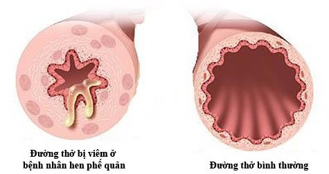 Picture 1 of 6 tips to help prevent bronchial asthma during the season