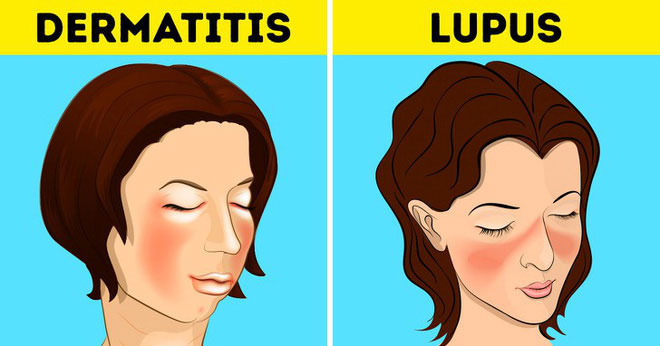 Picture 4 of 6 types of diseases are often easily misdiagnosed to other diseases