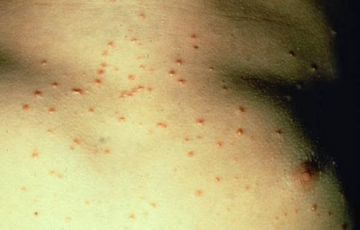Picture 6 of 7 mysterious diseases that make medicine