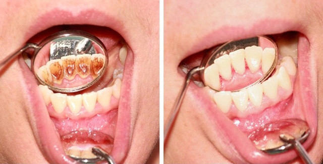 Picture 5 of 8 common mistakes when taking care of teeth