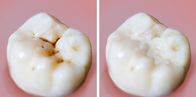 Picture 8 of 8 common mistakes when taking care of teeth