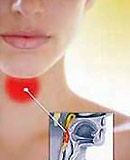 Picture 1 of 80% of sore throats should not use antibiotics