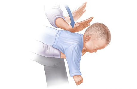 Picture 3 of 9 basic emergency skills everyone should know