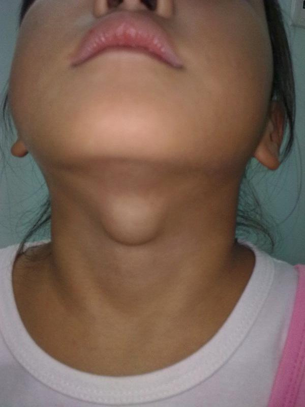 Picture 3 of 90% of people eat salty, but Vietnam is still the top iodine deficiency in the world because of this habit