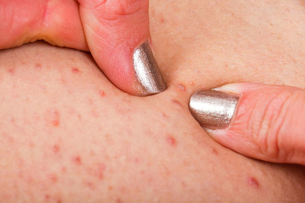 Picture 1 of A lot of acne can be a sign of the following 4 health problems