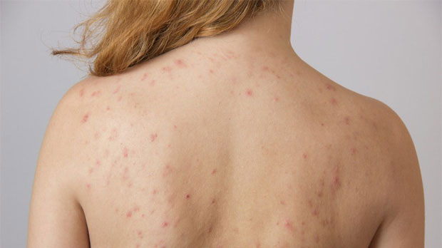 Picture 2 of A lot of acne can be a sign of the following 4 health problems