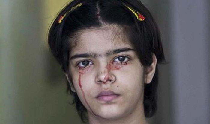 Picture 2 of A rare rare illness caused this girl to shed blood instead of sweat