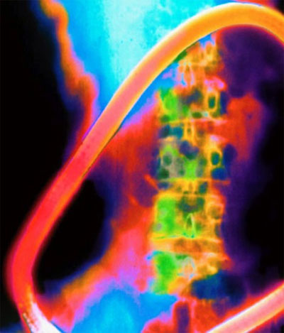 Picture 3 of A revolution in treating breast cancer