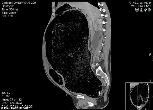 Picture 1 of Abdominal pain, diarrhea for 1 week, the man almost lost his life due to colon